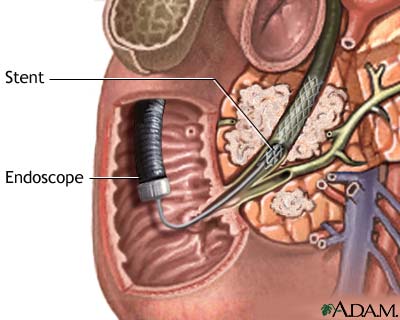 biliary-obstruction-series-3